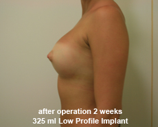 plastic-surgery-breast-augmentation